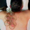 Cupping Therapy Provides More Than Just Pain Relief